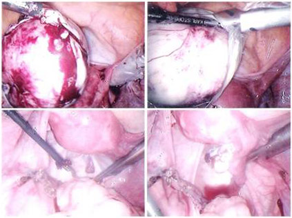 Ovarian Dermoid Cyst